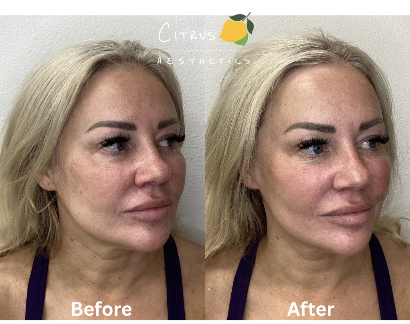 XERF vs. WonderTouch:&nbsp;Which Treatment Is Right for You?