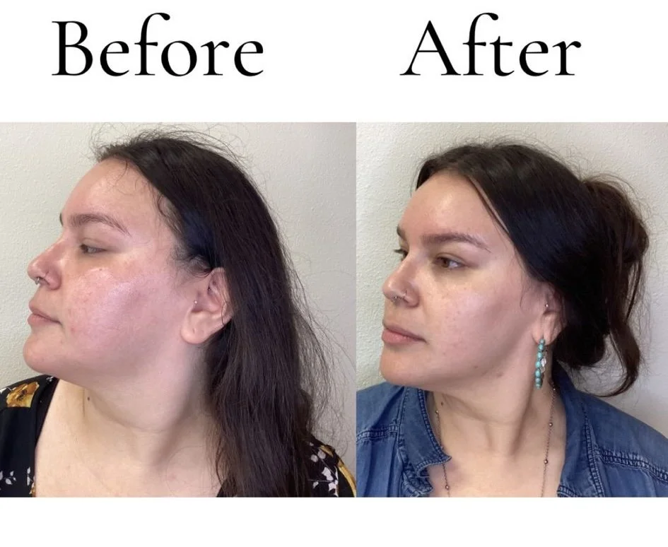 Your Fall Skin Reset: The Treatments to Consider After a California Summer