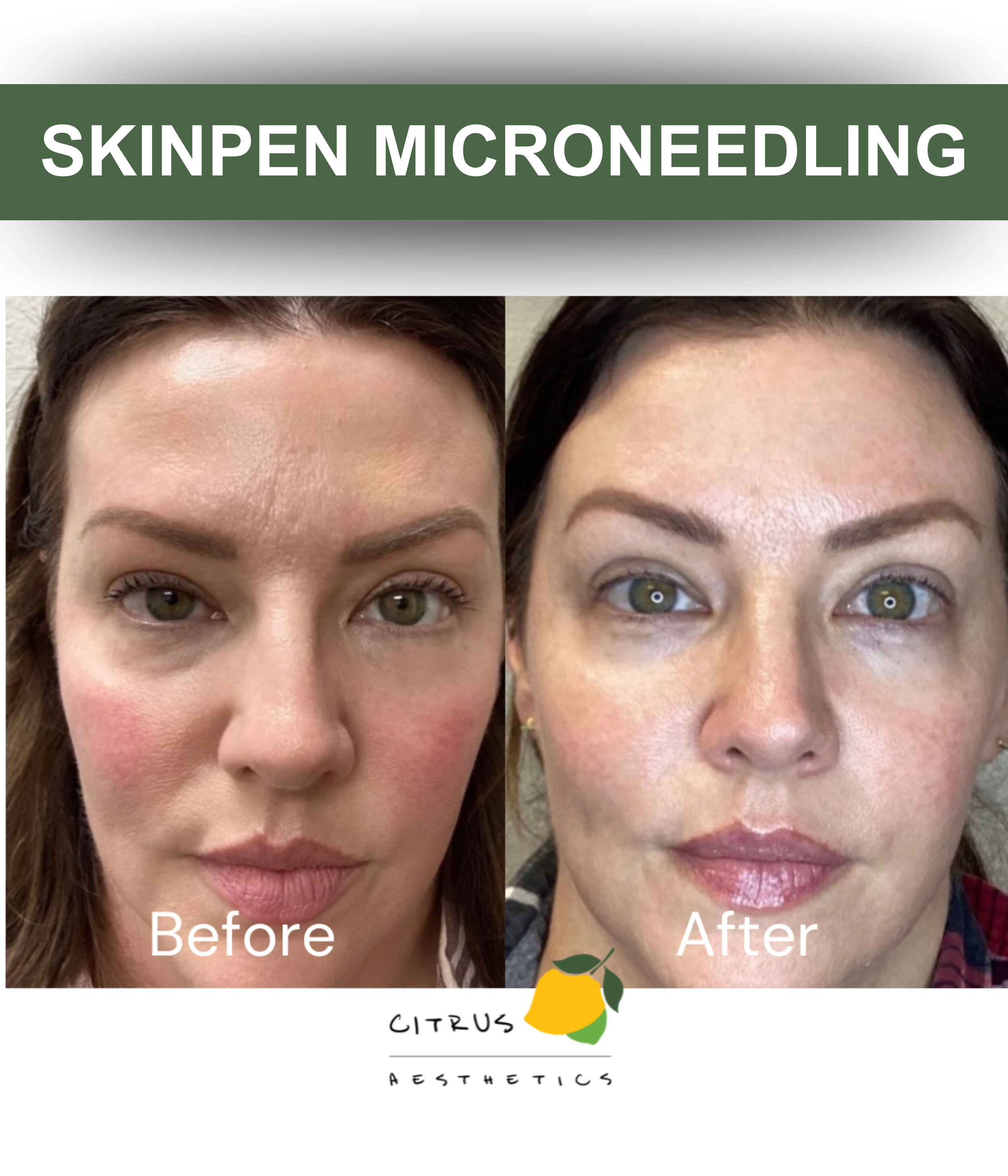 San Diego Aesthetic Med Spa | Citrus Aesthetics | A woman in orange scrubs administering a microneedling treatment to a patient with acne scars, with lemon slices and water splash graphics in the background.