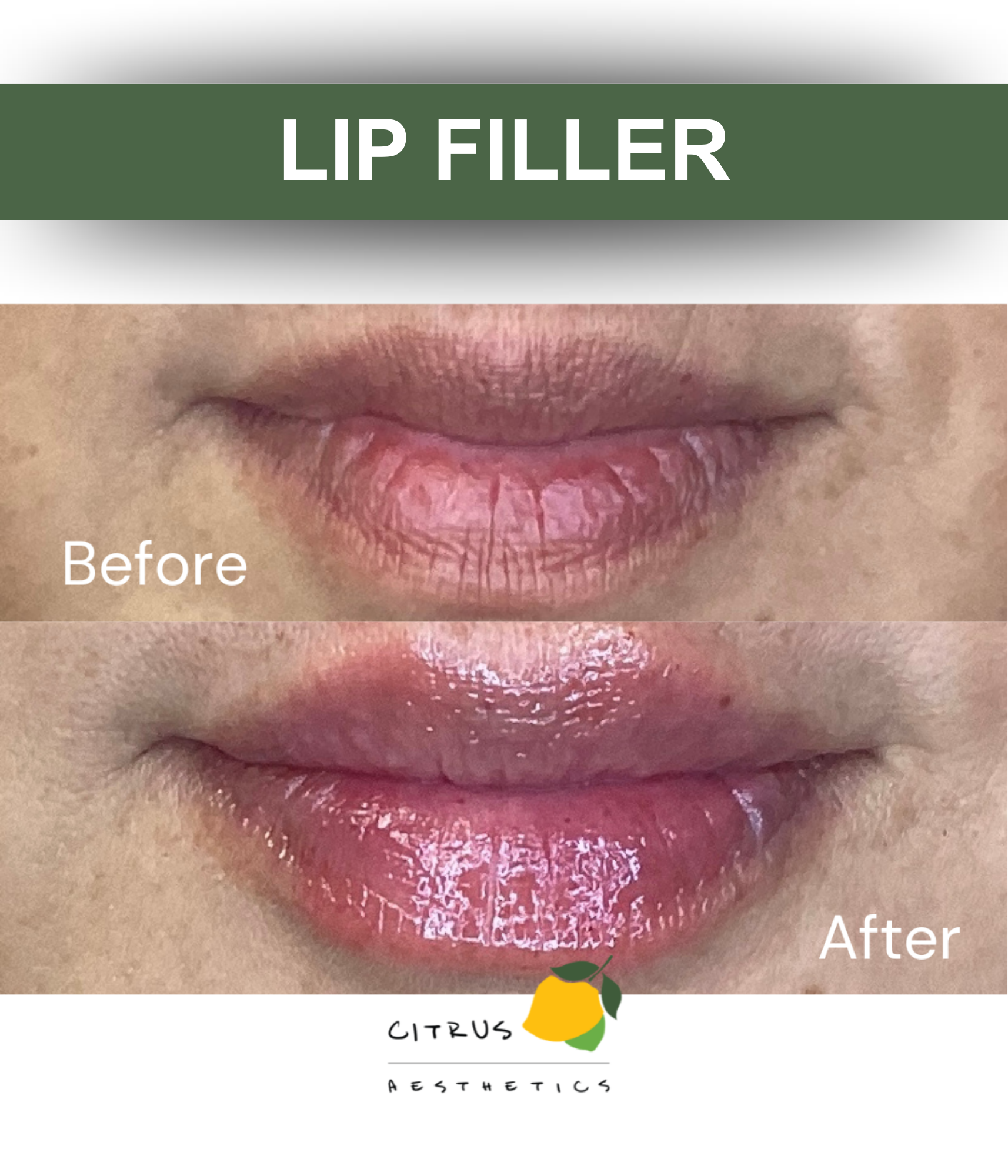 San Diego Aesthetic Med Spa | Citrus Aesthetics | A woman receiving a lip filler treatment from a professional. The background features lemon slices and water splash graphics with the text 'Lip Filler''.