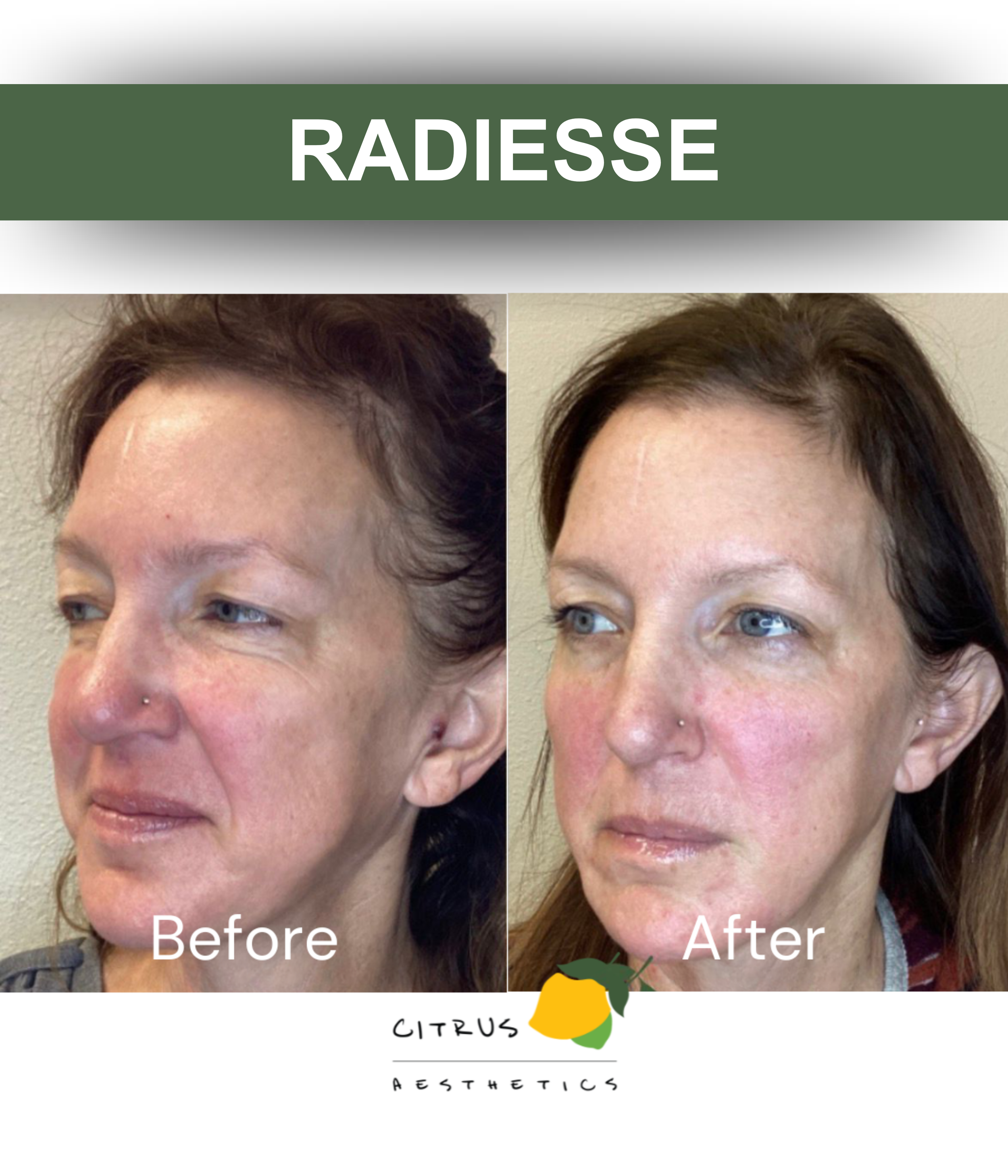 San Diego Aesthetic Med Spa | Citrus Aesthetics | A woman receiving a Radiesse treatment from a professional. The background features lemon slices and water splash graphics with the text 'Radiesse''.