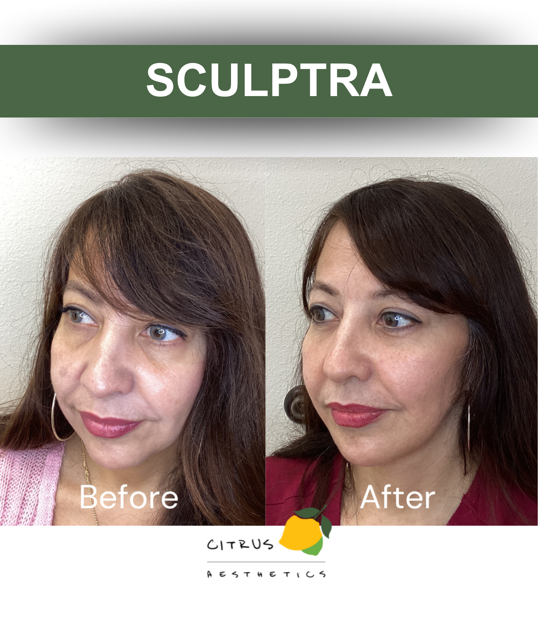 San Diego Aesthetic Med Spa | Citrus Aesthetics | The word 'SCULPTRA' appears on a green banner at the top.