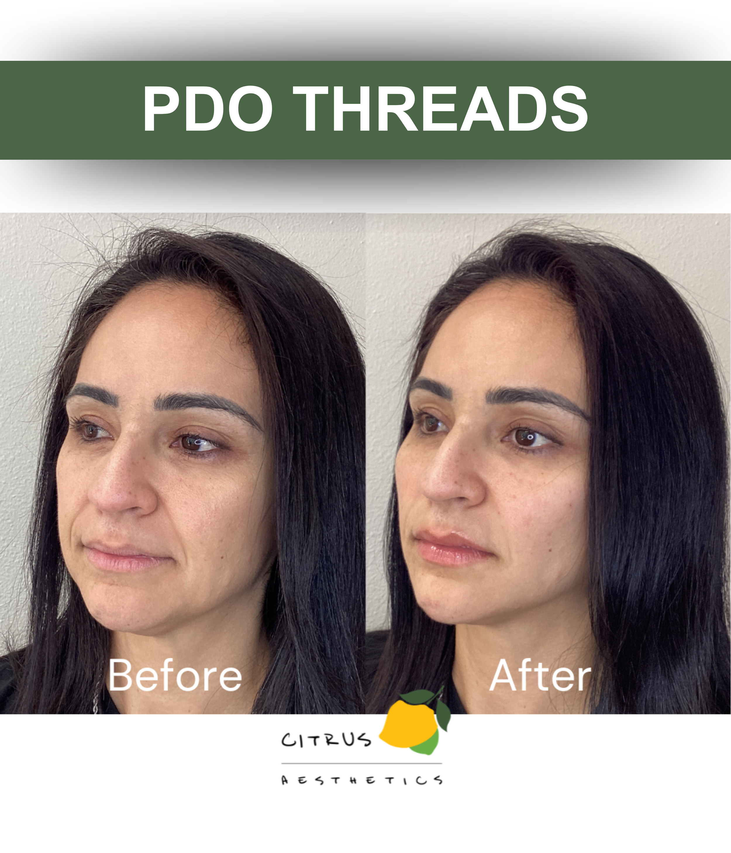 San Diego Aesthetic Med Spa | Citrus Aesthetics | A woman receiving PDO threads procedure on her forehead from a professional wearing blue gloves, with a background of lemon slices and water splashes.