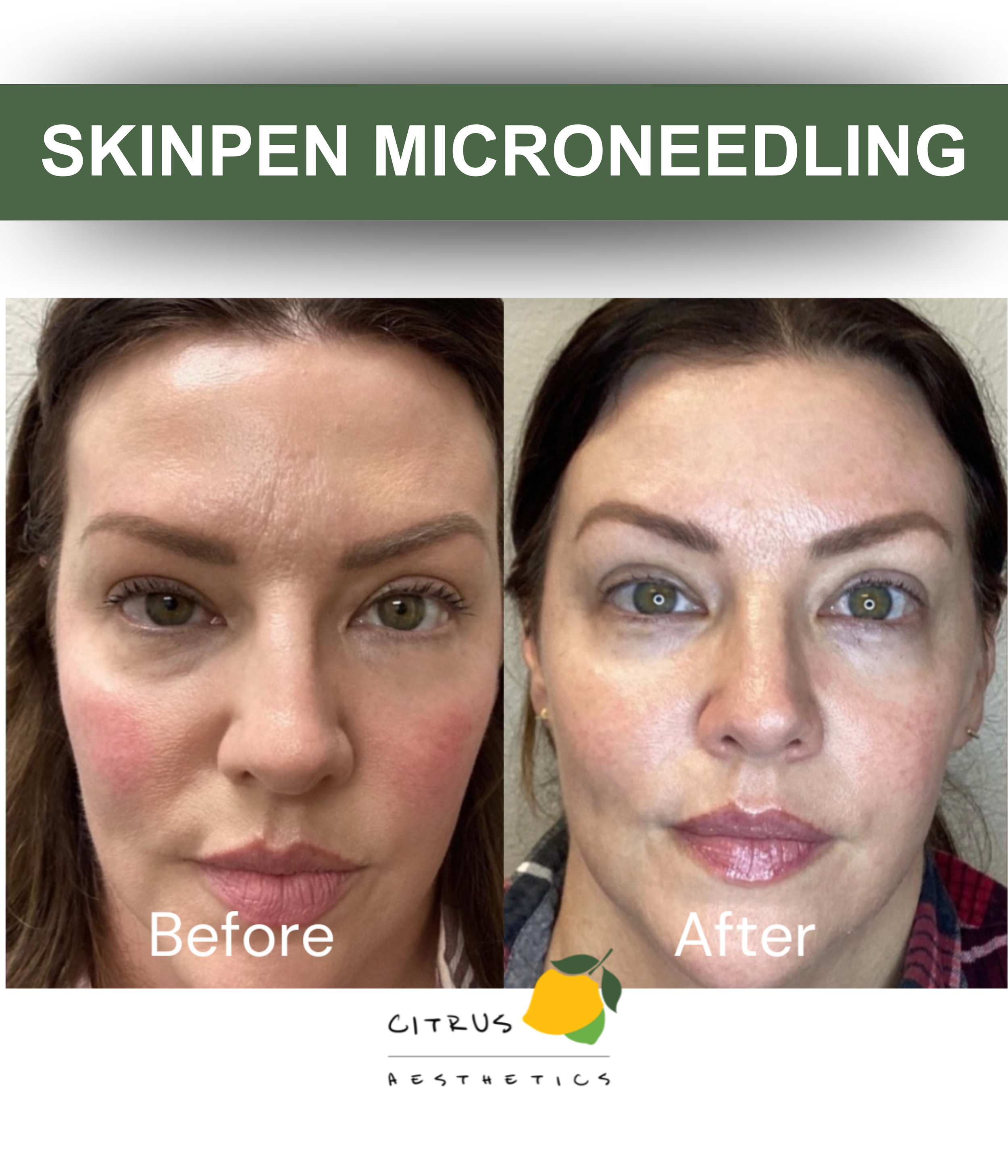 Citrus Aesthetics Microneedling