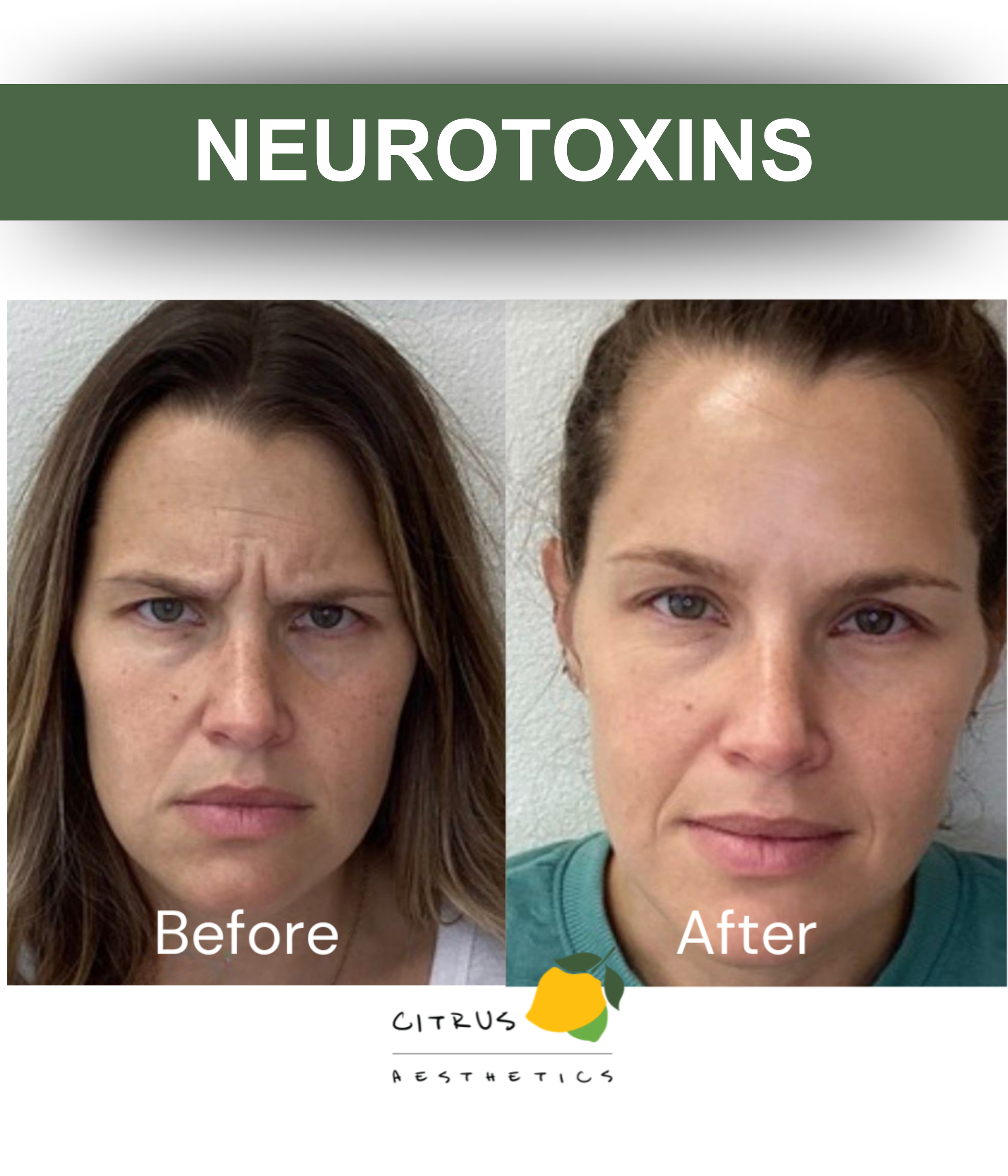Citrus Aesthetics Neurotoxins