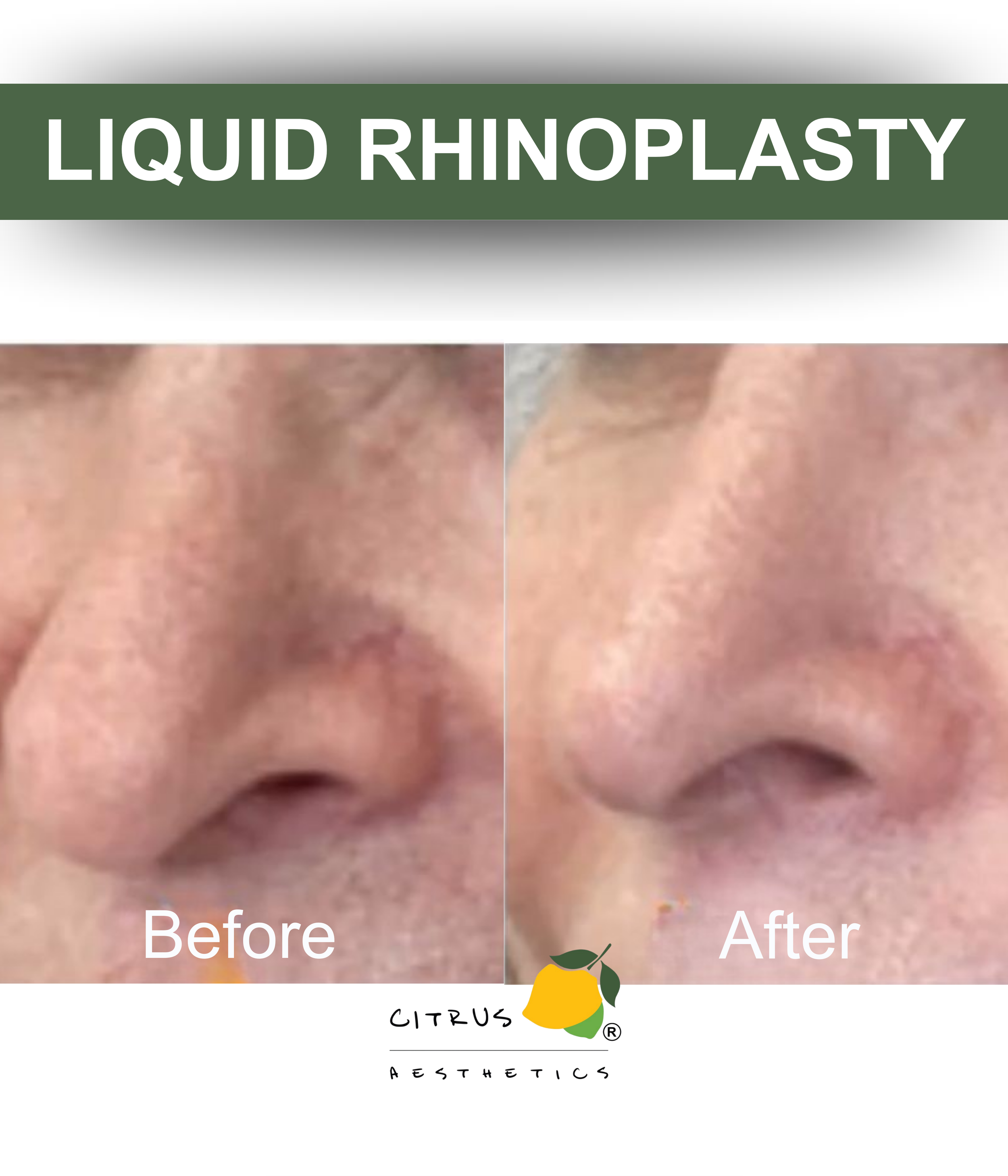 Liquid Rhinoplasty