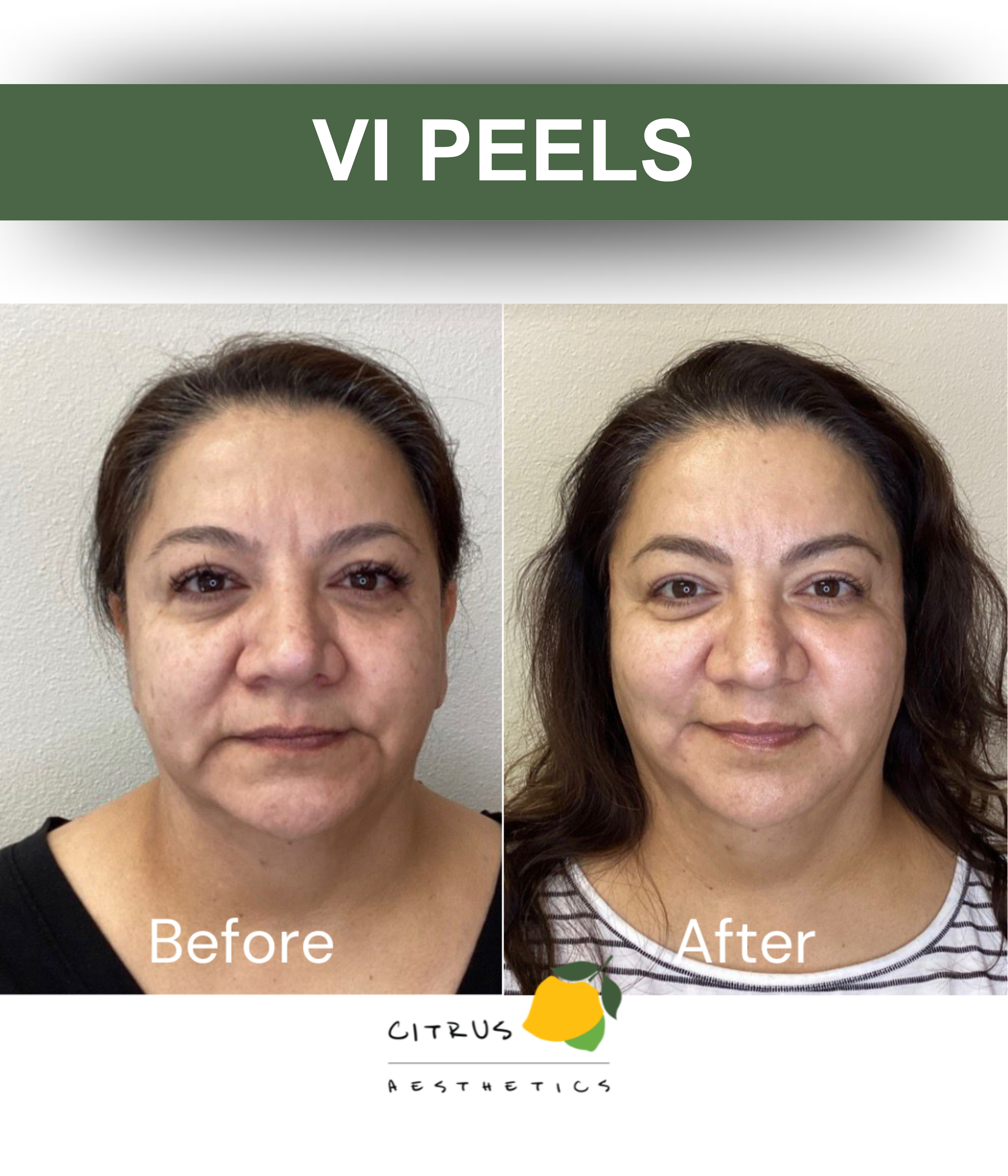San Diego Aesthetic Med Spa | Citrus Aesthetics | A woman receiving a skin peel treatment from a professional. The background features lemon slices and water splash graphics with the text 'Skin Peels'.