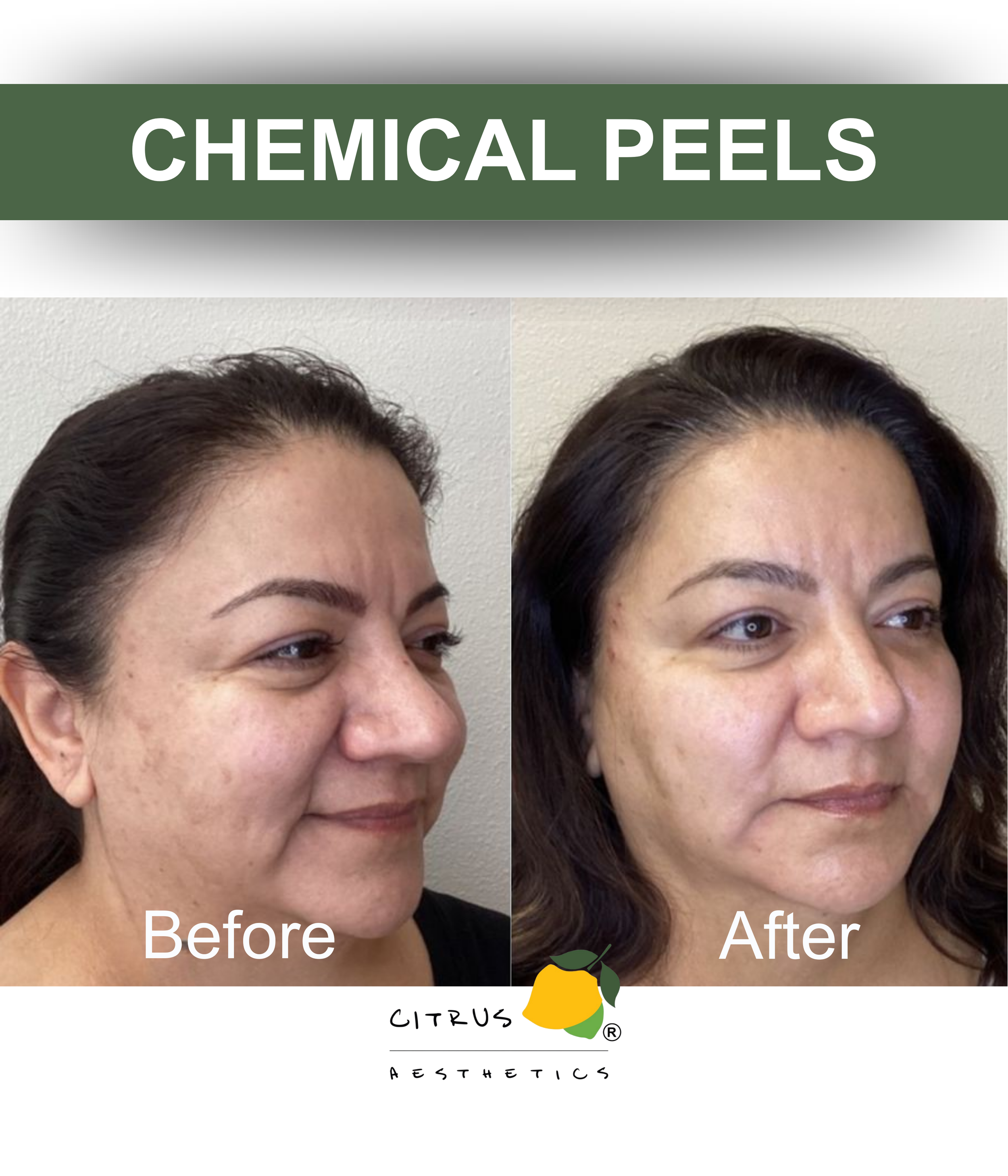 Chemical Peels