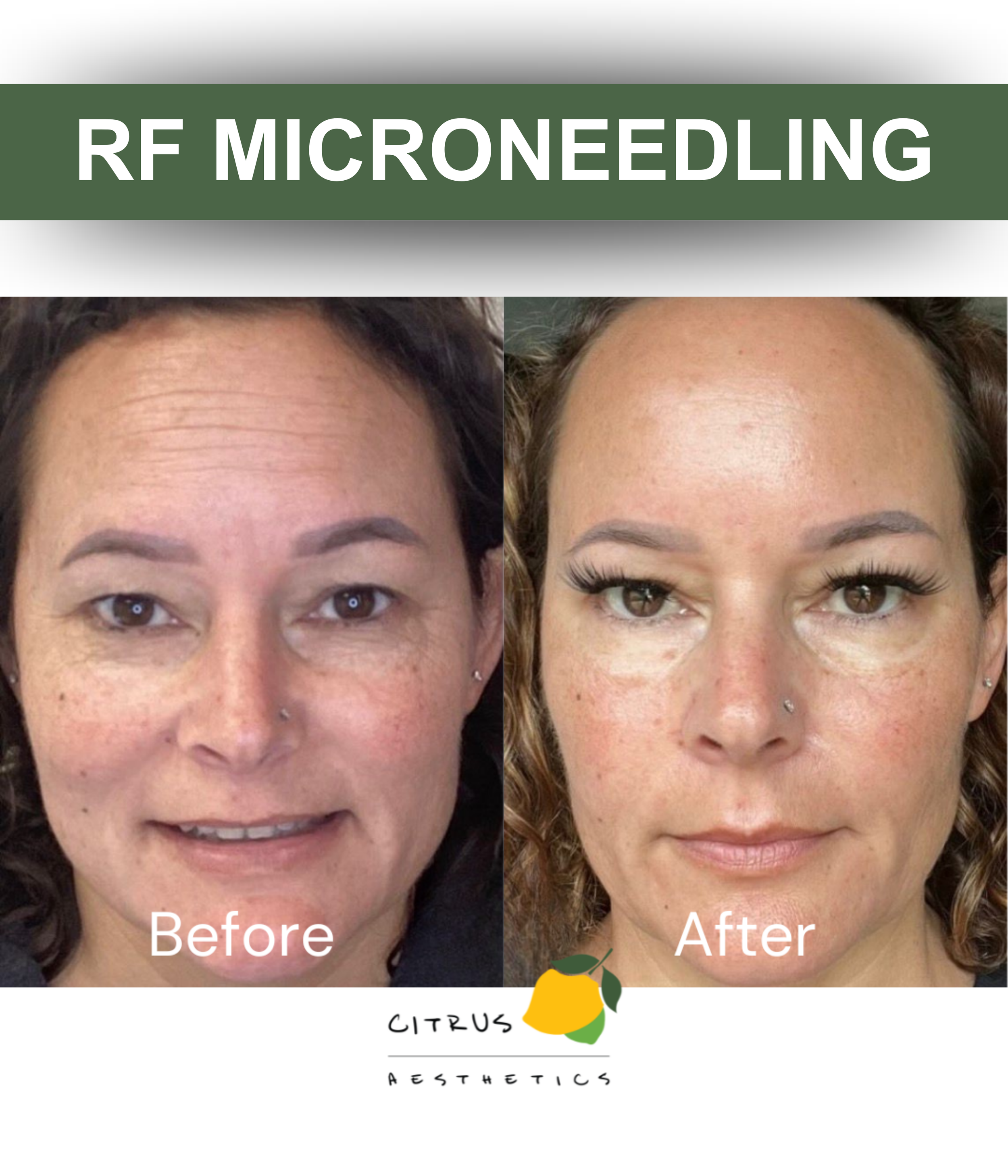 RF Microneedling