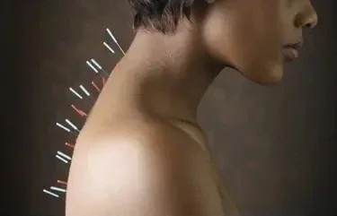 Side profile of a woman with colorful acupuncture needle therapy on her back and neck area.