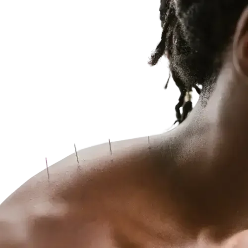 Image of acupuncture needling on a shoulder.
