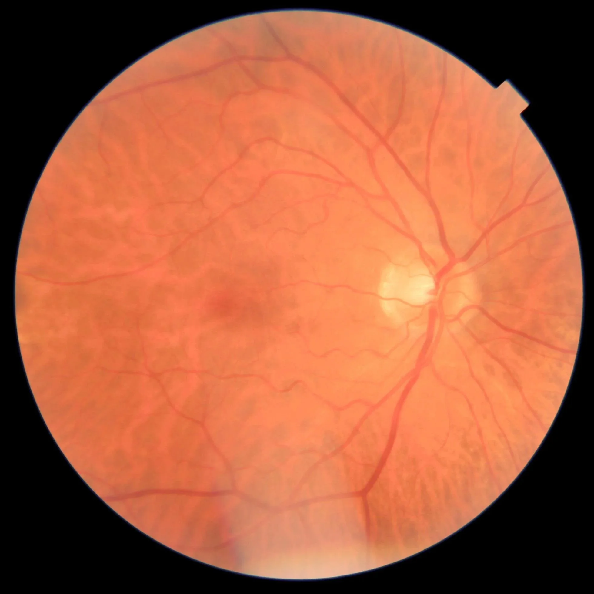 Augenhintergrund (Fundus) mit Makula und Gefäßen