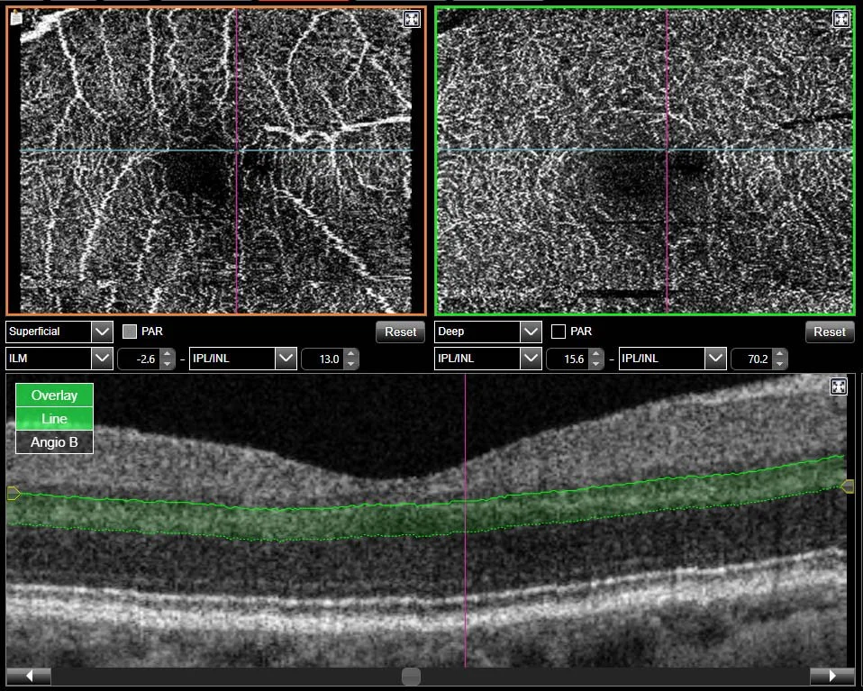OCT-Bild des Auges mit Darstellung der Retina, darunter zwei Querschnittbilder der Netzhaut.