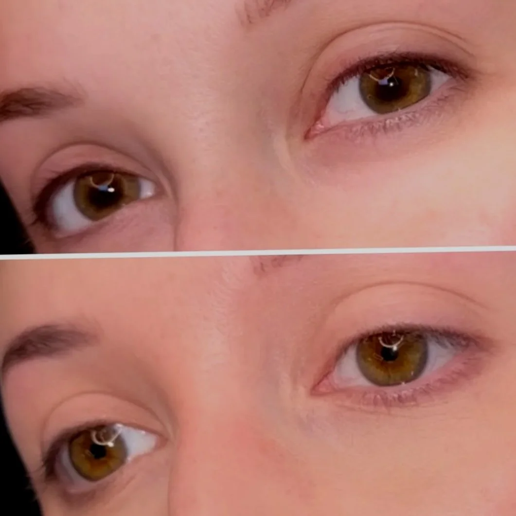 Upper eyelid Eyelash Enhancement before and after with natural definition