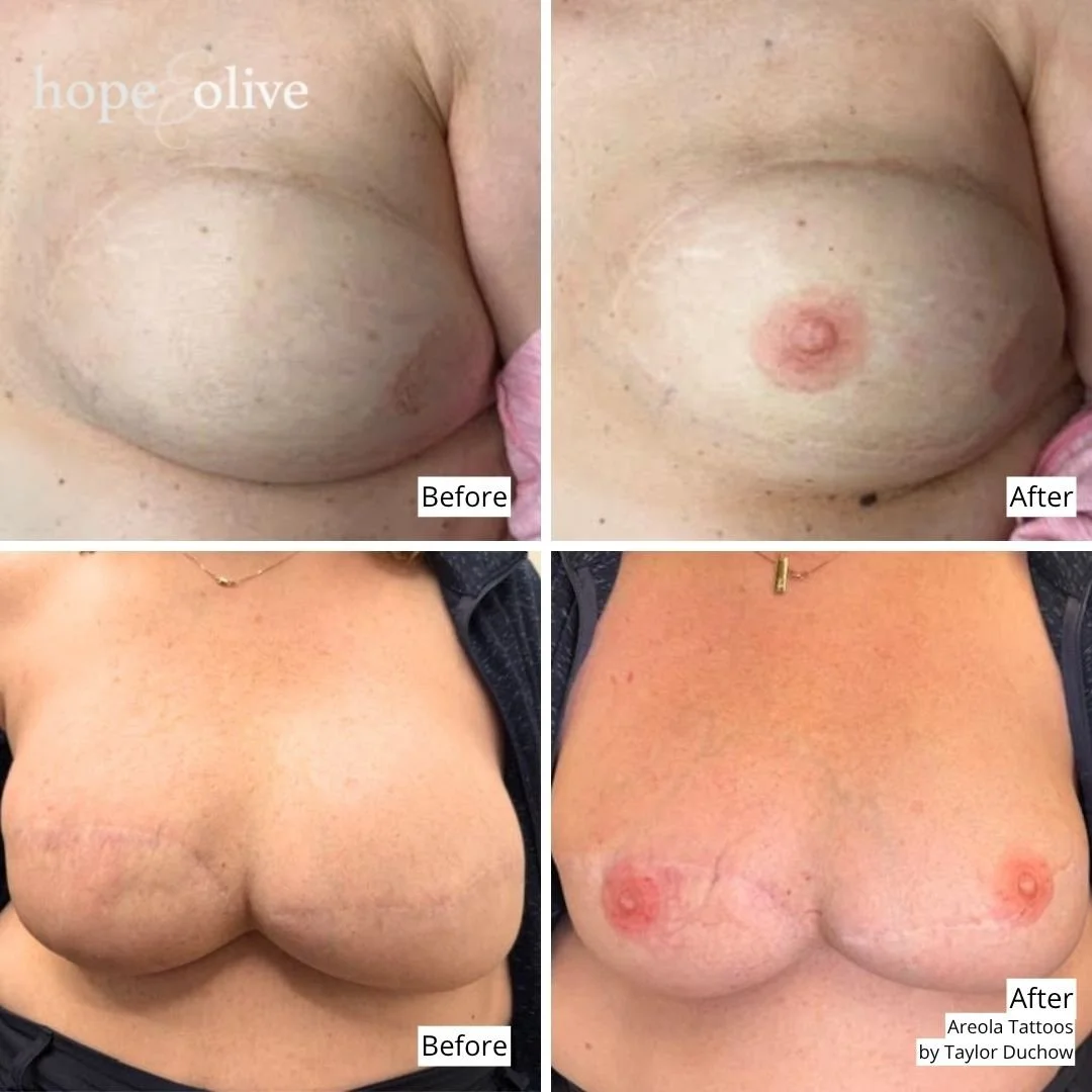 Comparison of before and after images of breast and chest tattoos, showing the removal process. The top set shows a breast with a previous tattoo and the same breast after tattoo removal, revealing the skin. The bottom set shows a cleavage area with 