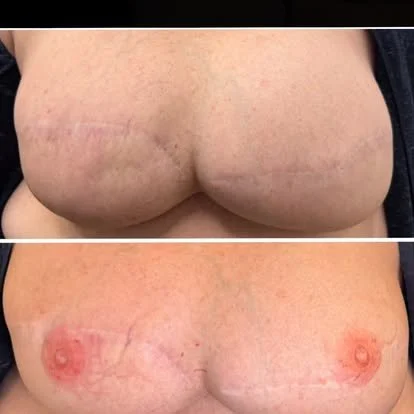 Before and after nipple and areola tattoo blending with natural skin tones