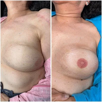 Areola Restoration before and after showing realistic 3D effect