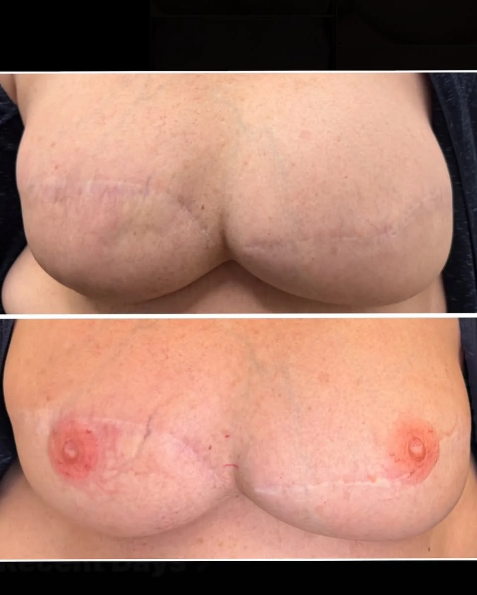 Comparison of a person's chest before and after a procedure, showing scars and healing process.