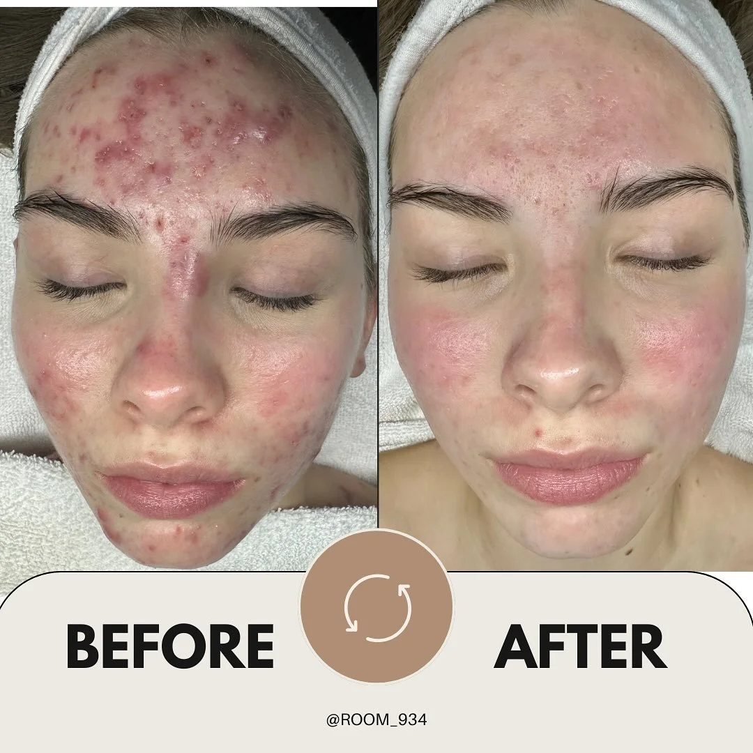 Proof that results takes time, but it&rsquo;s always worth it 🤍

Acne doesn&rsquo;t define you- but how you show up for yourself does. Her journey isn&rsquo;t over but&hellip; 🤯 what progress! This is the result of hard work, patience and dedicatio