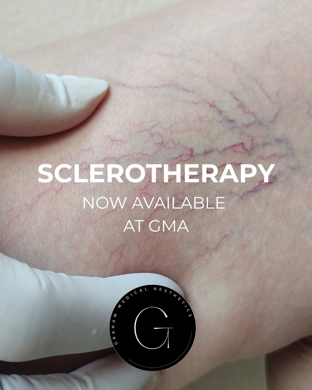 ✨ NEW SERVICE ANNOUNCEMENT ✨

SCLEROTHERAPY is now available at Graham Medical Aesthetics!

We&rsquo;re excited to expand our treatment options with Sclerotherapy &mdash; a safe and effective injectable solution for reducing the appearance of unwante
