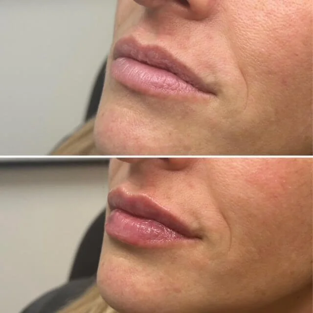 BeforeAfterLipsTNY.jpg
