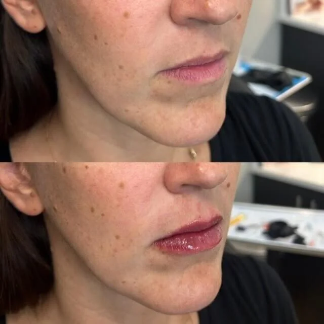 BeforeAfterLips2TNY.jpg