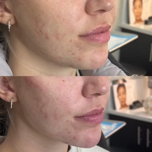 BeforeAfterLowerFaceTNY.jpg