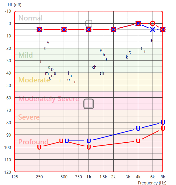 De-identified standard audiogram