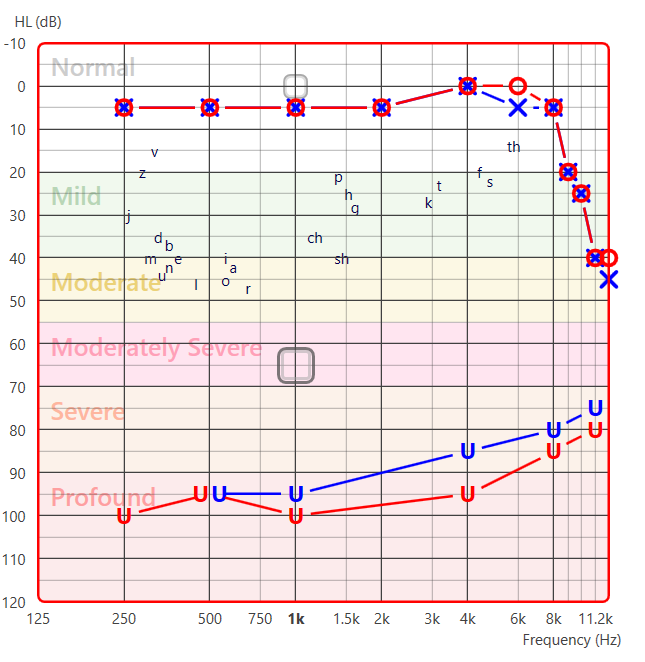 De-identified extended high-frequency audiogram