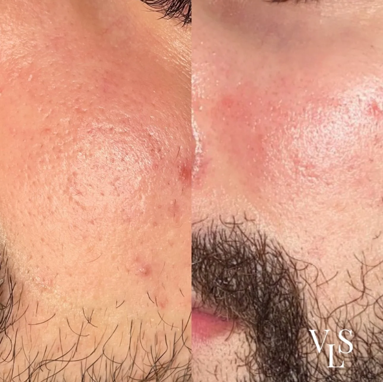 MICRONEEDLING BEFORE & AFTER