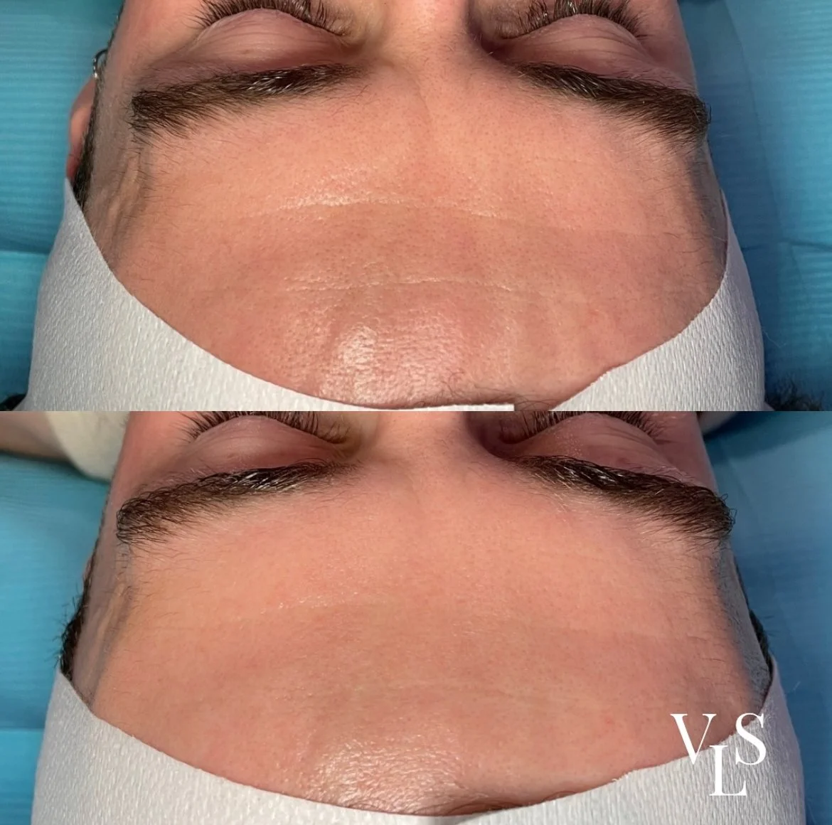 HYDROFACIAL BEFORE & AFTER