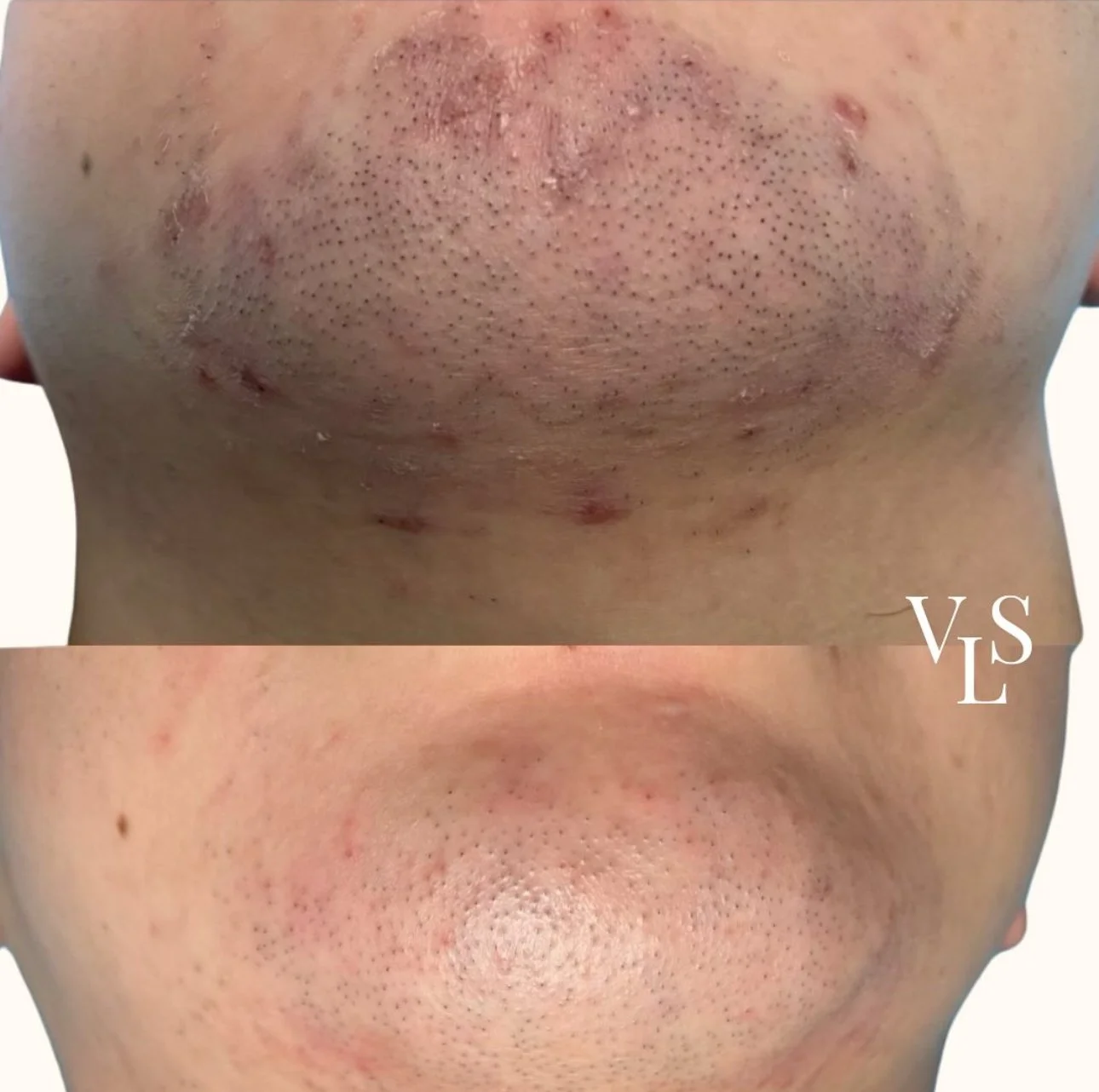 LASER HAIR REMOVAL BEFORE & AFTER