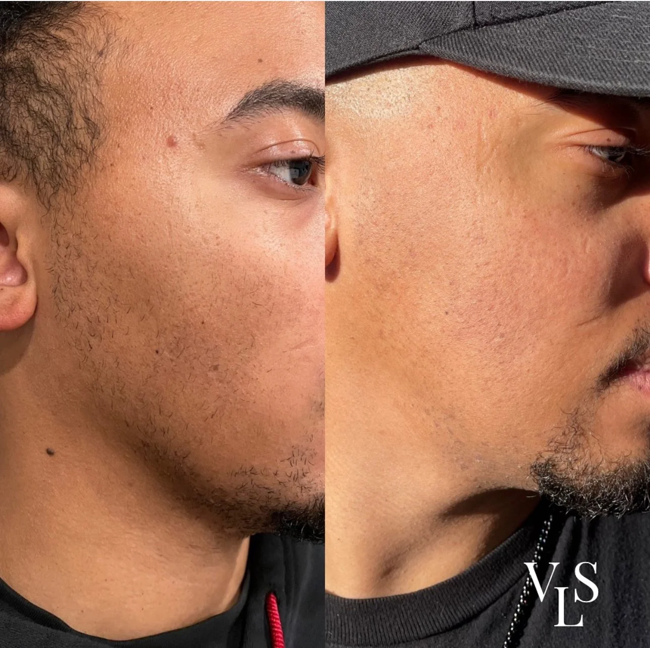 CHEMICAL PEEL BEFORE & AFTER