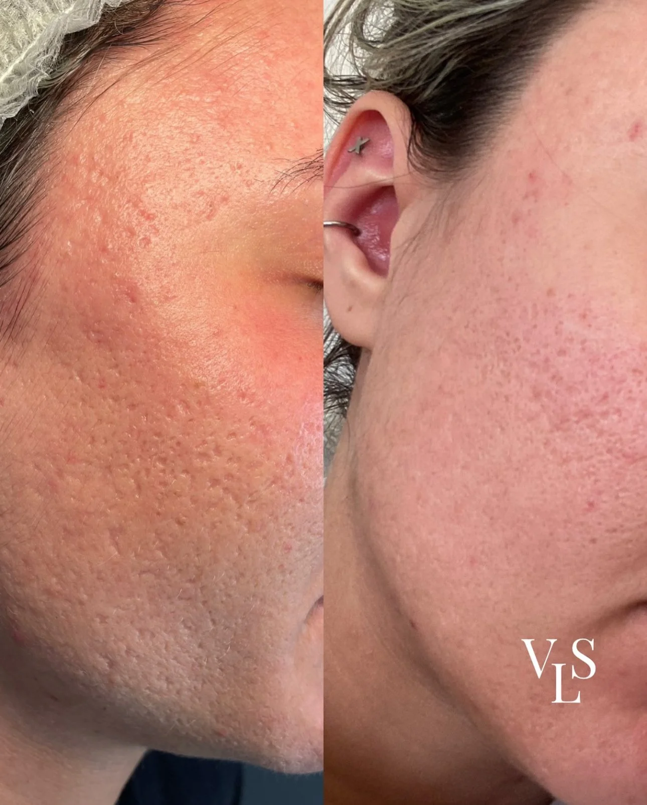 MICRONEEDLING BEFORE & AFTER