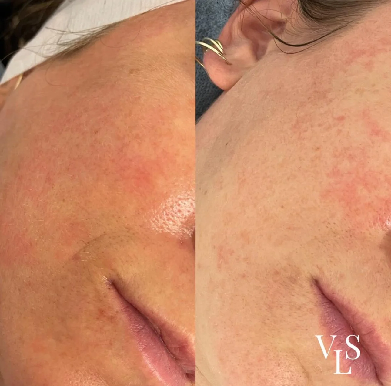 MICRONEEDLING BEFORE & AFTER