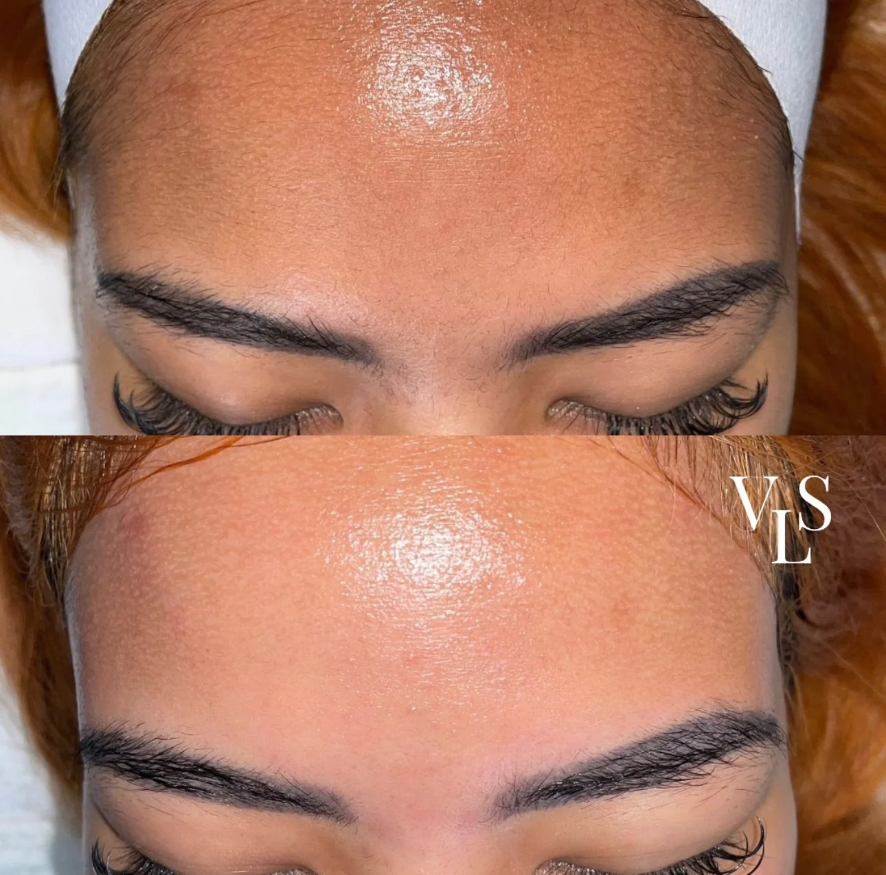 DERMAPLANING BEFORE & AFTER