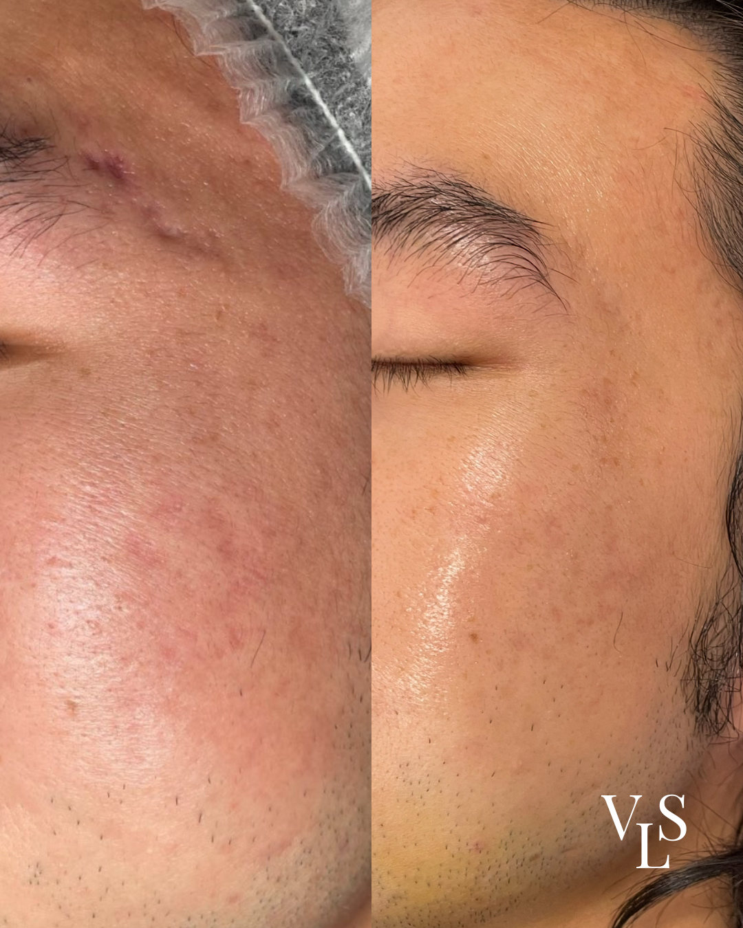 MICRONEEDLING BEFORE & AFTER
