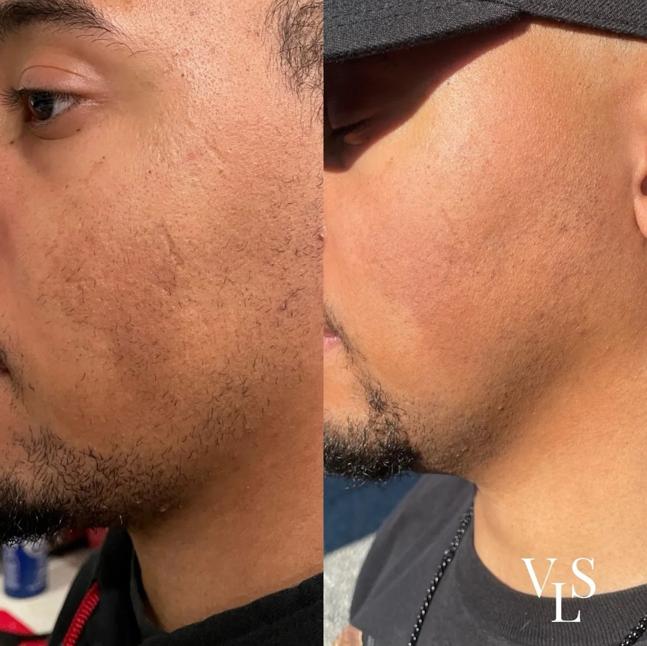 CHEMICAL PEEL BEFORE & AFTER