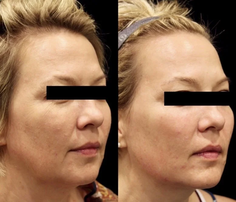 Kybella in Phoenix, AZ 85020 | Goodjuju Aesthetics