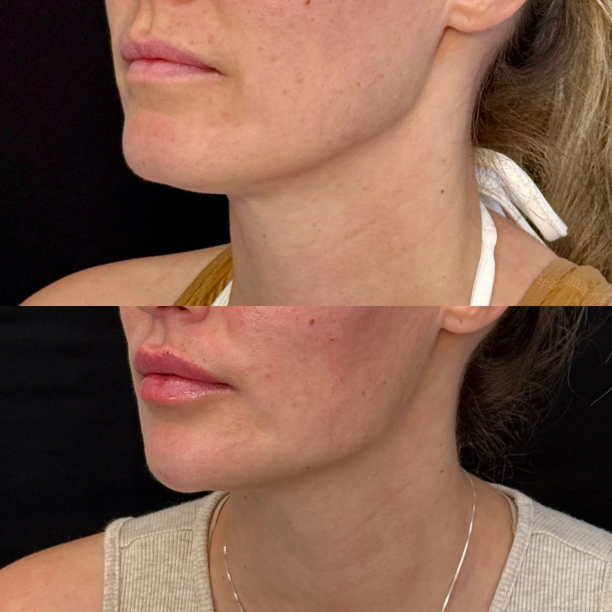 Juvederm in Phoenix, AZ 85020 | Goodjuju Aesthetics