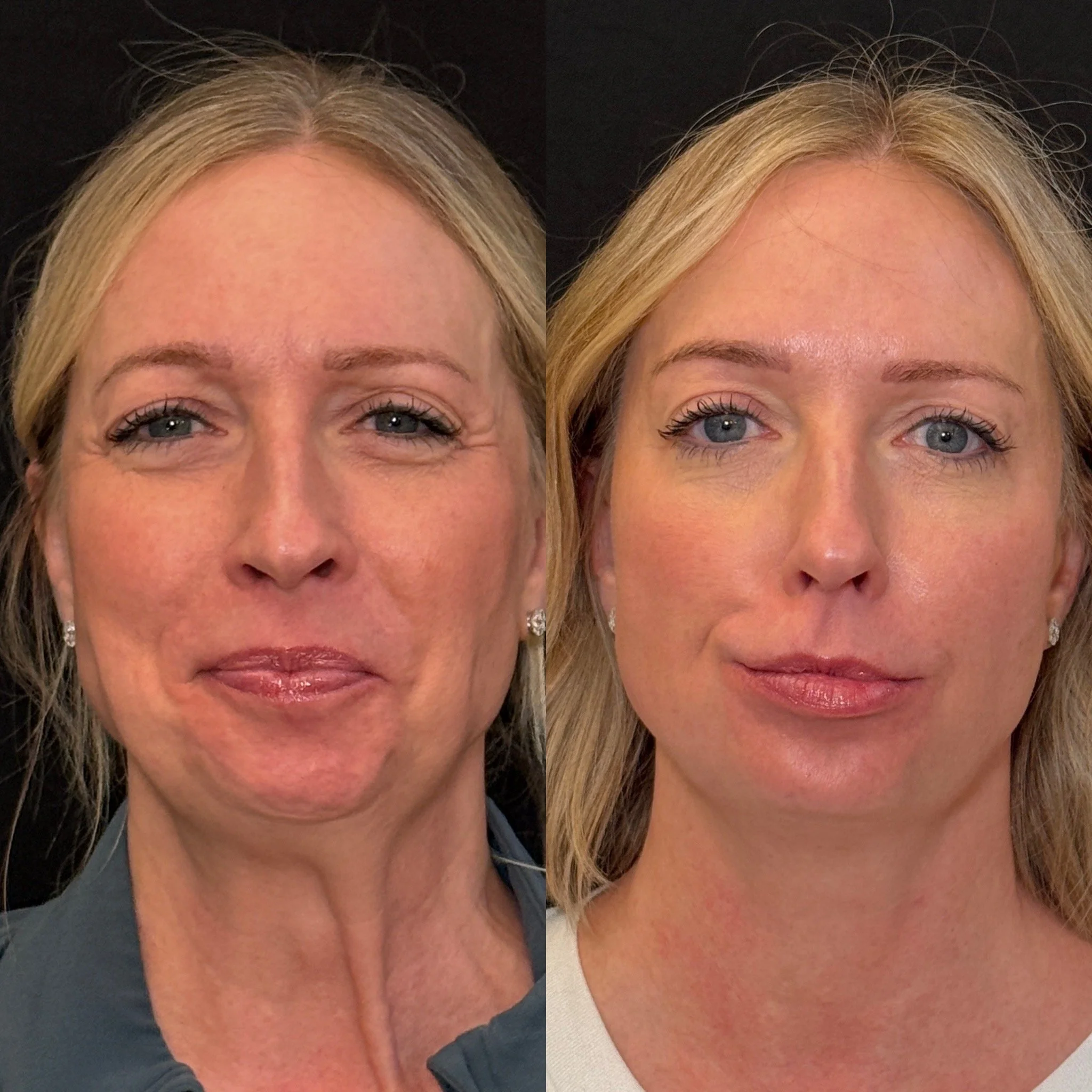 Botox in Phoenix, AZ 85020 | Goodjuju Aesthetics