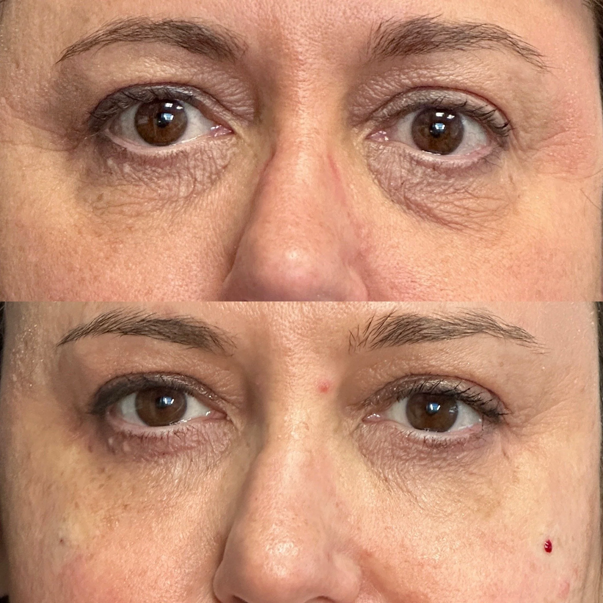 PRF Ez Gel in Phoenix, AZ 85020 | Goodjuju Aesthetics