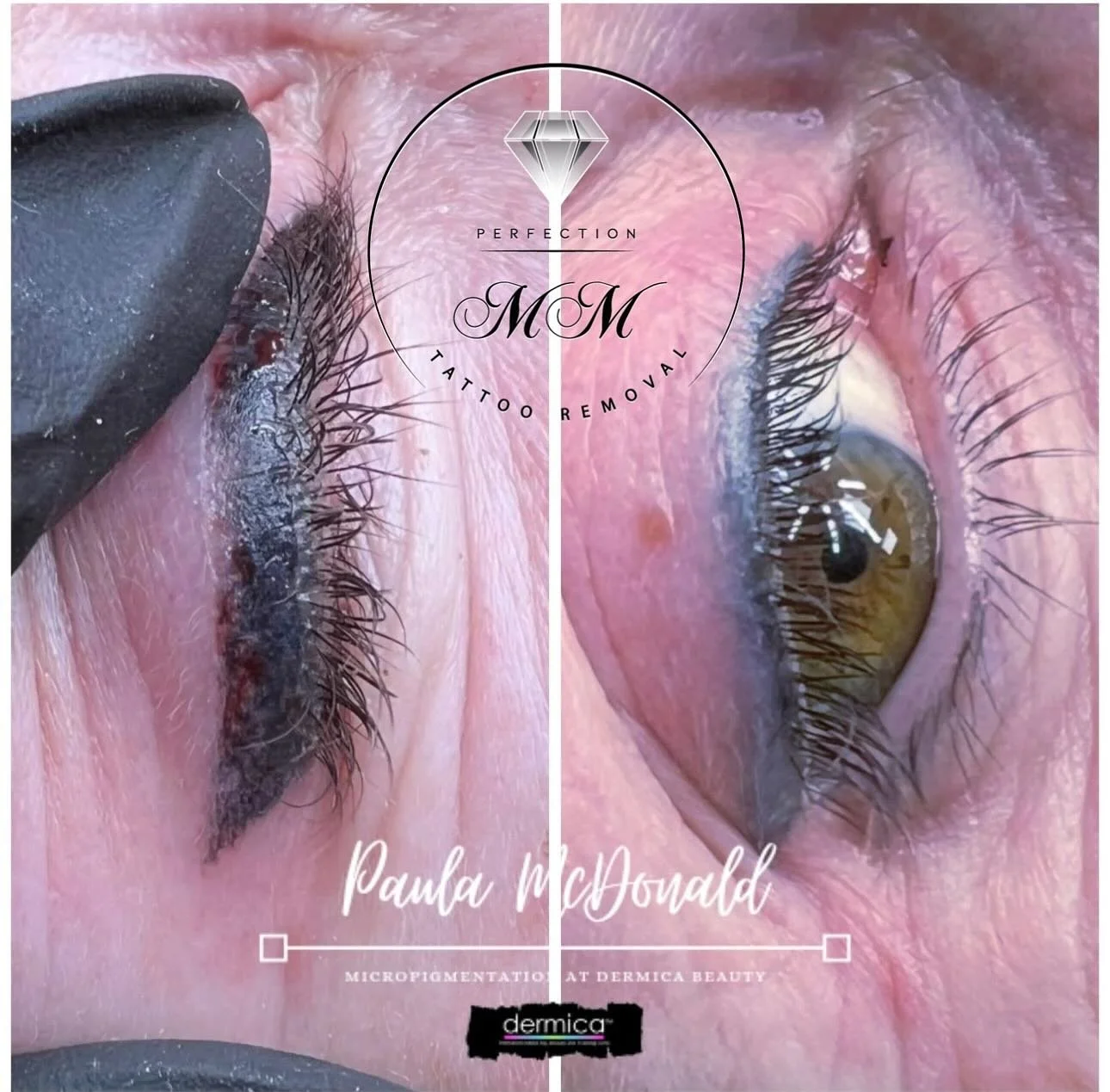 MM removal &hellip; one session. A little bottle of pure magic from @dermicabeauty ✨ 

This liner was mega! Very happy with that heal, still some work to go but this is actually very soft and charcoal toned in the flesh and much smaller and less hars