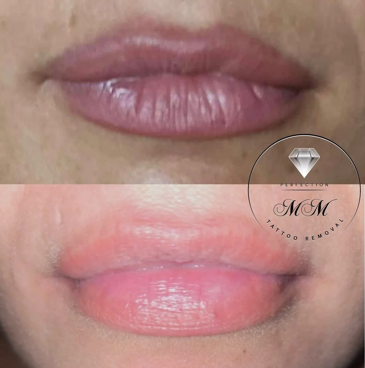 Amazing work by our MM tattoo technician Corin France @scinco.pmuandbeauty 

MM Tattoo Removal&rsquo;s unique formula is a non-colour selective product, safe  for any skin types and effective on all areas of the body unlike many alternative removal m