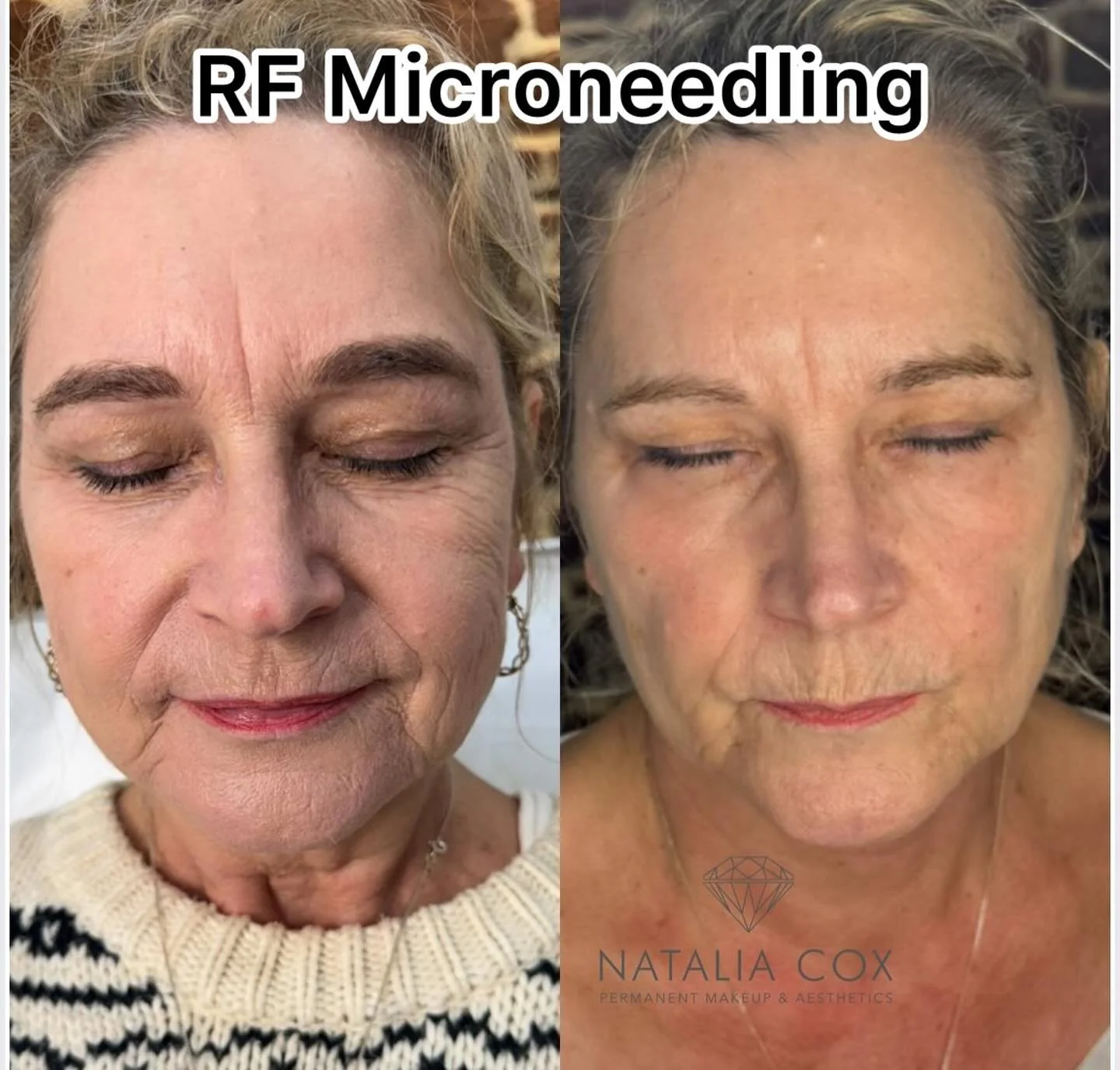 Visible results after one RF microneedling session:

✅ Improved skin tone and reduced pigmentation.
✅ Softening of fine lines, especially marionette lines.
✅ Smoother texture and refined pores.
✅ Increased firmness and radiance, especially on the nec