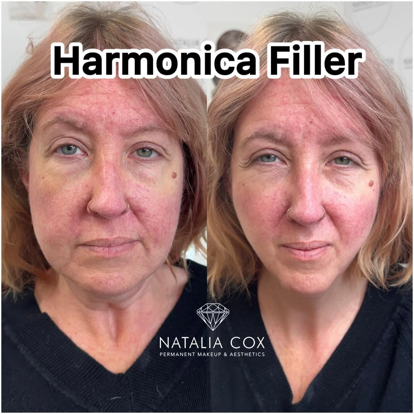 ✨Harmonica Filler Transformation✨

Harmonica filler is all about restoring structure, softening lines, and giving the face a lifted, rejuvenated look&mdash;without changing who you are. It works gradually and harmoniously with your own facial contour