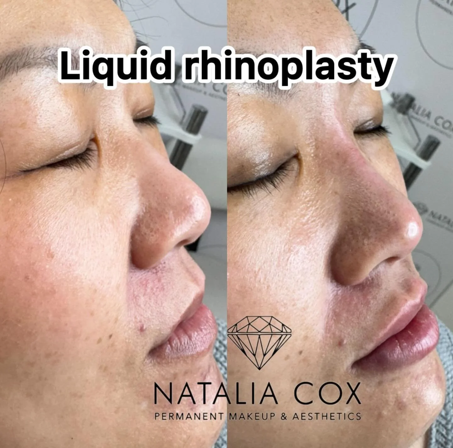 Non-Surgical Nose Enhancement with Dermal Filler (Asian Nose Profile) ✨

Dermal filler rhinoplasty is a popular option for Asian clients who want a more balanced and refined nose without surgery. This treatment can help:
✔️ Smooth a low or flat nasal