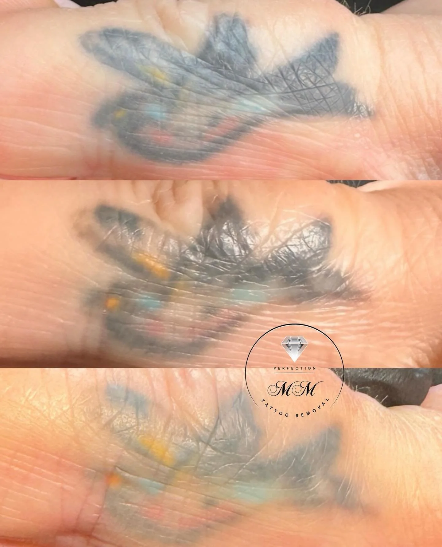 First MM success 😍 for @browhouse_ashleighcrighton_pmu 

&ldquo;Finger tattoo before
Then After 5 laser sessions, knowing it would be slow but tried MM Tattoo Removal and the bottom is it healed from 1 session 🥰🙌🏼&rdquo;

✨ This is exactly why MM