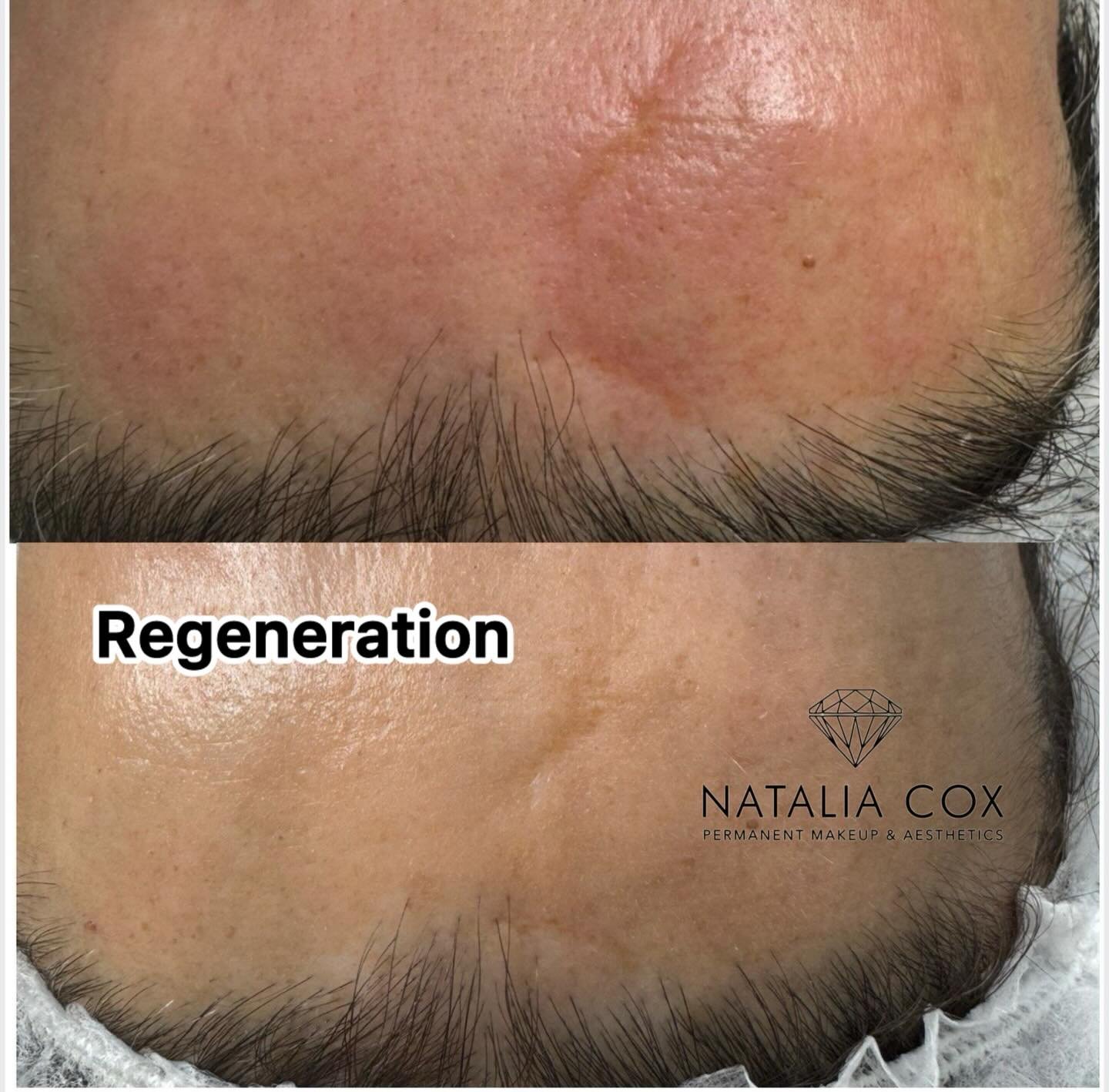 RF microneedling for scar regeneration and hair growth: 
✅ Microneedles deliver radiofrequency energy into the dermis. 
✅ Neocollagenesis and tissue remodeling are activated. 
✅ The appearance of atrophic and hypertrophic scars is reduced. 
✅ Microci