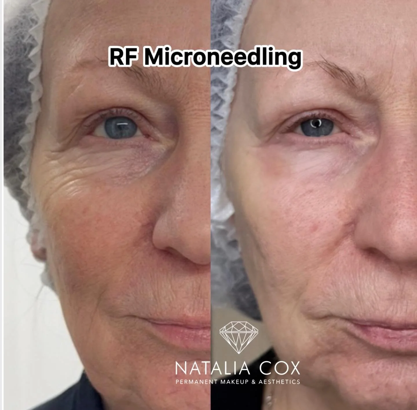Before ➡️ After ✨

Skin, but make it renewed.

This transformation is the result of RF Microneedling &mdash; designed to stimulate collagen, improve texture, and smooth fine lines over time. Notice the brighter tone, refined pores, and overall firmne